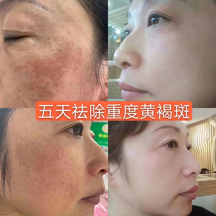 祛斑液适用于片斑 黄褐斑 铅汞斑 黑黄脸