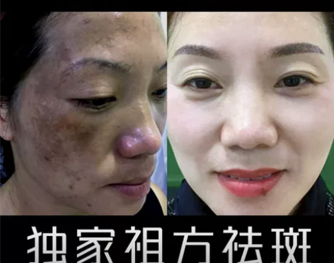 祛斑祖方 黄褐斑雀斑色斑美白去黄祛斑霜膏液...